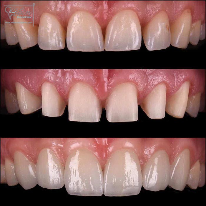 چندین راه برای بستن فاصله دندان وجود دارد مثل لمینت و کامپوزیت